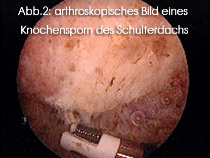 arthroskopisches Bild eines Knochensporn des Schulterdachs