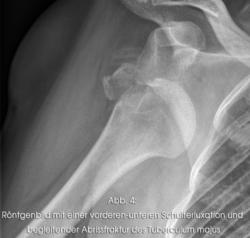 Röntgenbild mit einer vorderen-unteren Schulterluxation und begleitender Abrissfraktur des Tuberculum majus