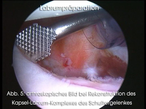 arthroskopisches Bild bei Rekonstruktion des Kapsel-Labrum-Komplexes des Schultergelenkes