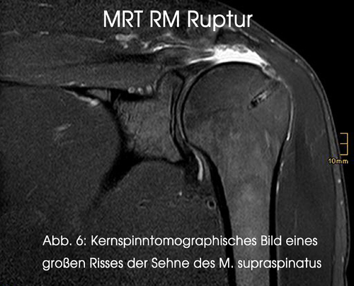 Kernspinntomographisches Bild eines großen Risses der Sehne des M. supraspinatus